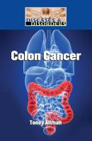 Colon_cancer