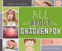 All_about_chickenpox